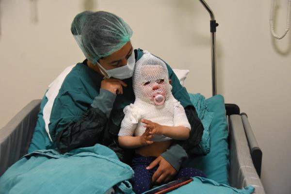 AFYONKARAHISAR'DA UZERINE SICAK SU DOKULMESI SONUCU VUCUDUNDA YANIKLAR OLUSUN 15 AYLIK BERIL SERVER AKTAS, AMBULANS HELIKOPTERLE GETIRILDIGI ESKISEHIR SEHIR HASTANESI YANIK MERKEZINDE TEDAVI ALTINA ALINDI. COCUK CERRAHISI UZM. DR. SAMI APAK, MINIK BERILIN BASINA VE GOGSUNE YANIK FILESI TAKILDIGINI VE HAYATI TEHLIKESININ OLMADIGINI IFADE EDERKEN, ANNE FATMA AKTAS (28) ISE BEN MUTFAGA KAHVALTI HAZIRLAMAYA GIRMISTIM, KIZIM DA ODADAYDI. NE ARA GELDI BILEMEDIM, SICAK SUYU UZERINE CEKTI. SAG OLSUN HELIKOPTERDEKI SAGLIK CALISANI COK ILGILENMIS. COK TESEKKUR EDIYORUM HERKESE SEKLINDE KONUSTU. (FOTO:ENGIN OZMEN/ESKISEHIR-DHA)